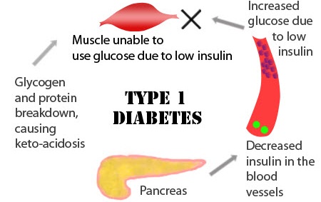type-1-diabetes